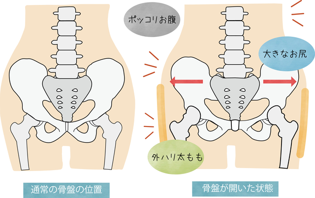 骨盤の開く原因