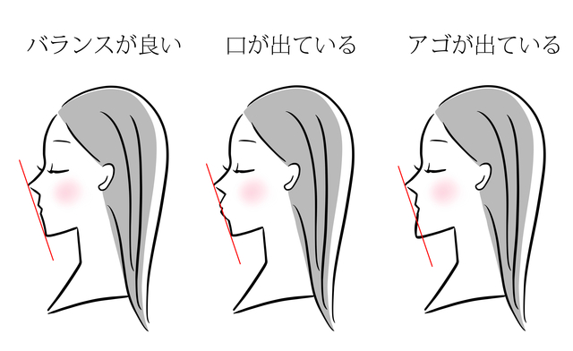 鼻が高くなる　歯列矯正