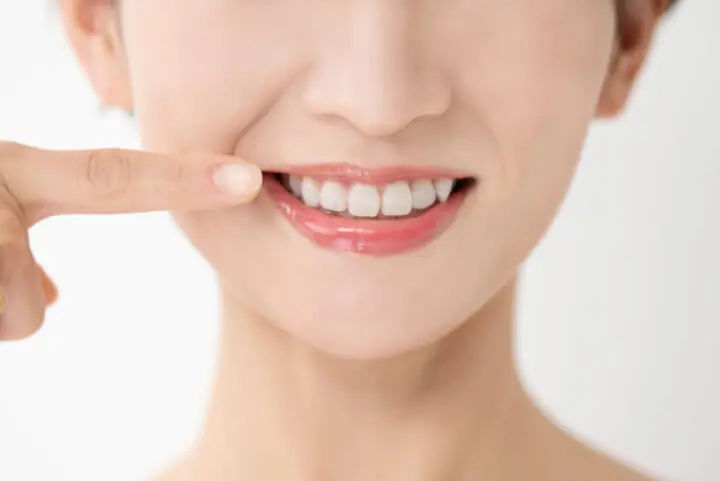 矯正 ほうれい線